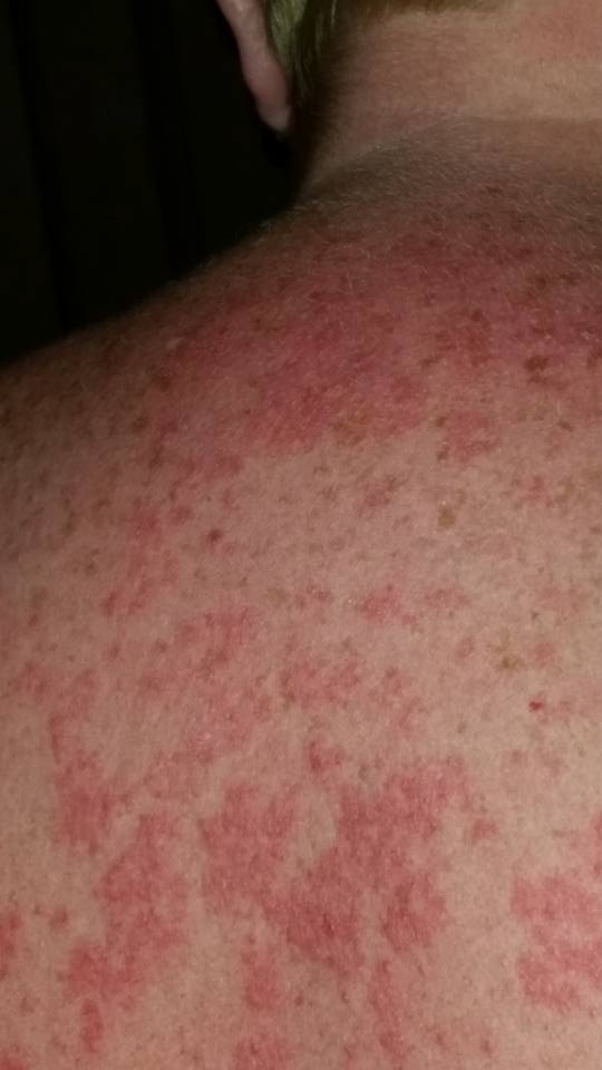 Coping with Itchy Rashes - LUPUS UK