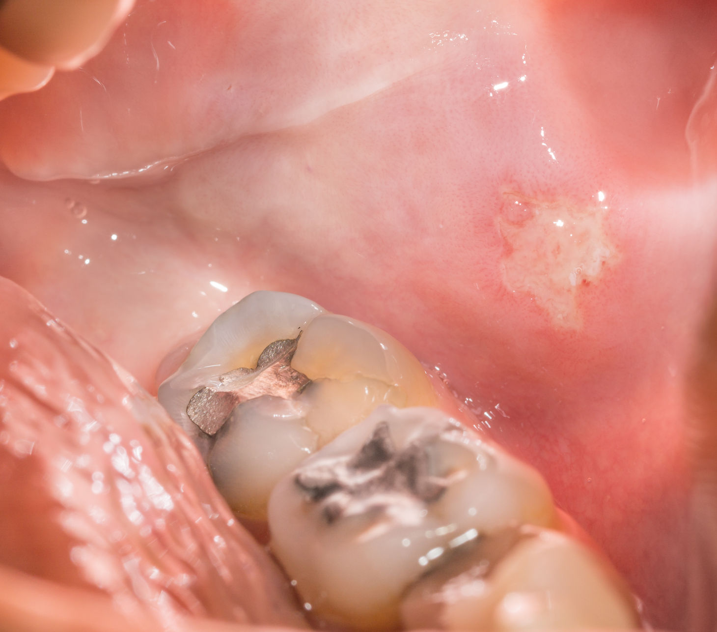 34651833 - closeup view of back tooth and sore, open mouth