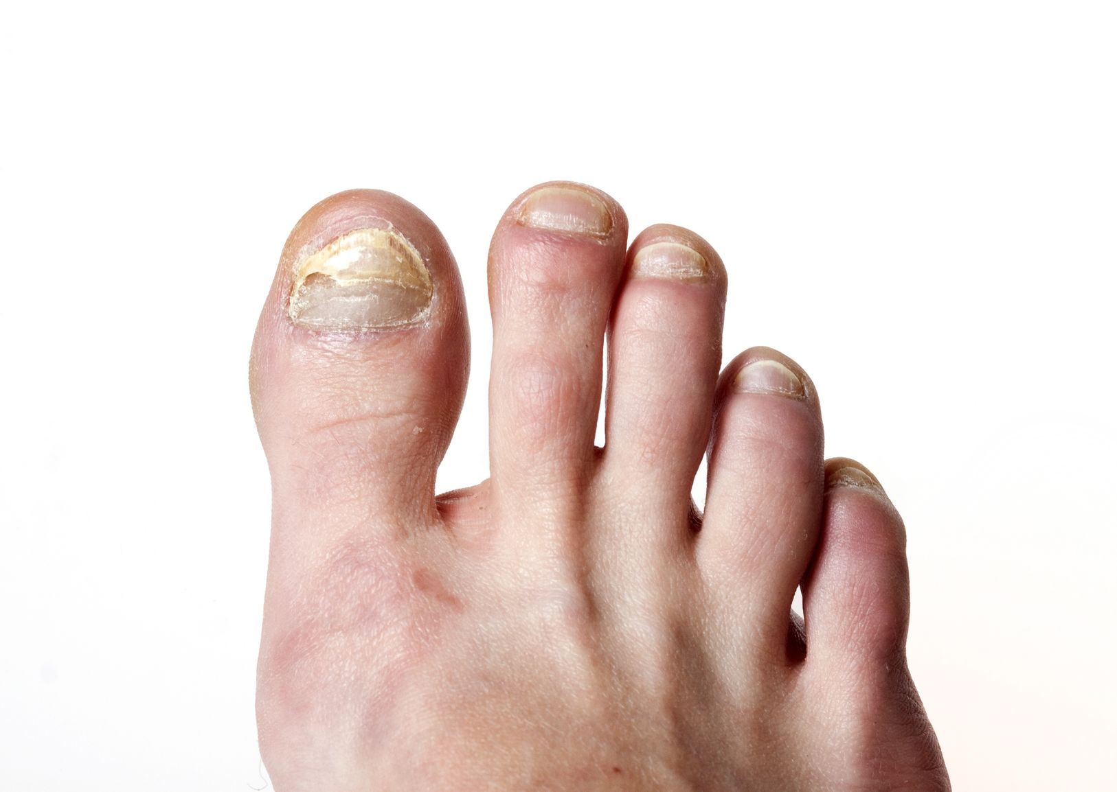 The Worst of the Worst: How Bad Can Nail Fungus Get? | GNFO
